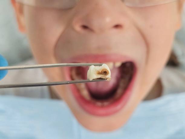 Best Emergency Tooth Extraction in Edgeworth, PA